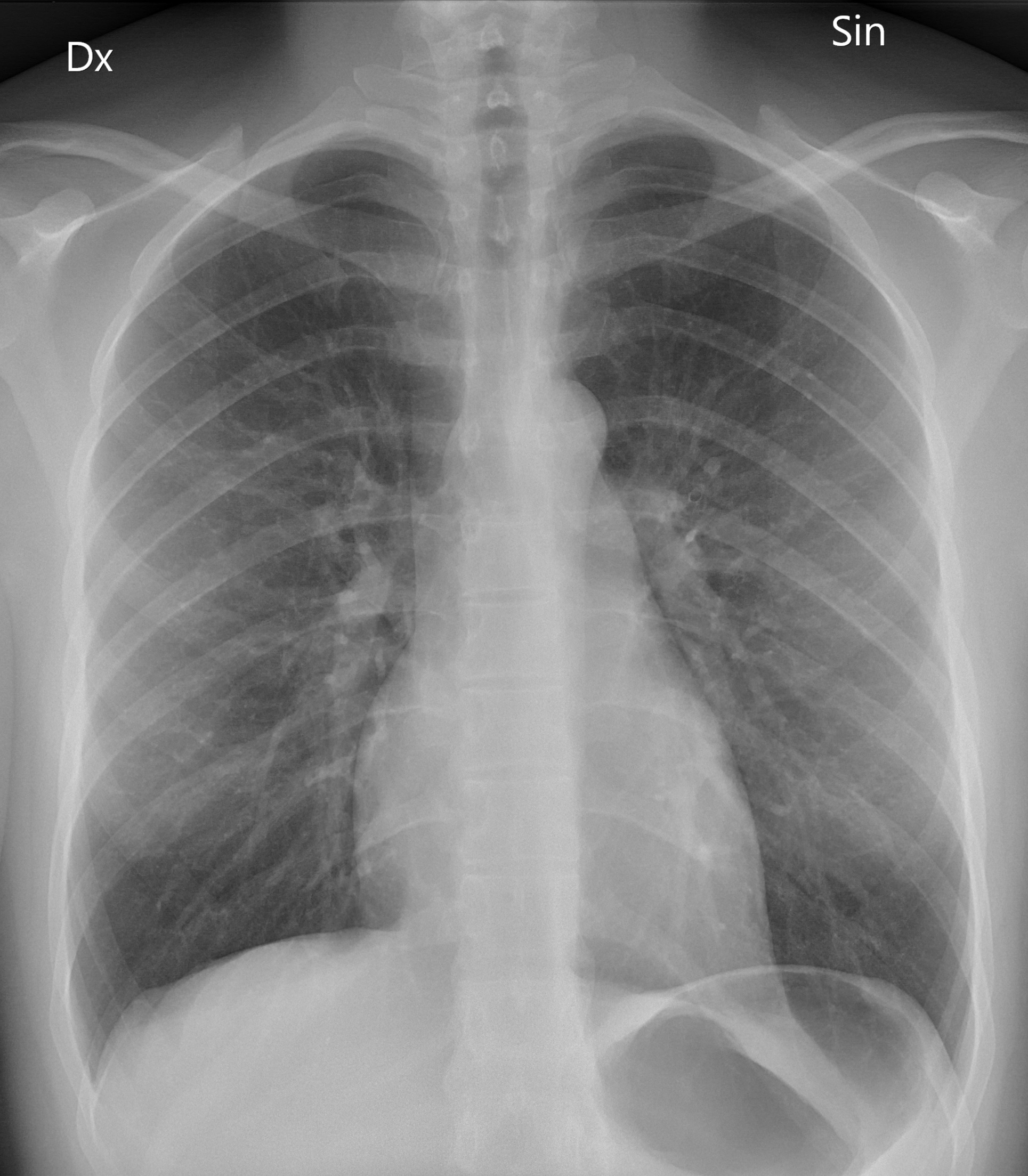 Radiografía posteroanterior de tórax con pulmones y silueta cardiaca visibles