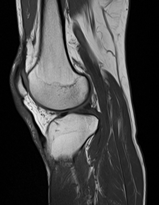Resonancia magnética de rodilla con anatomía articular visible en corte sagital