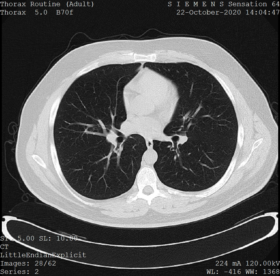 Corte axial de tomografía computarizada de tórax donde se distinguen corazón y pulmones