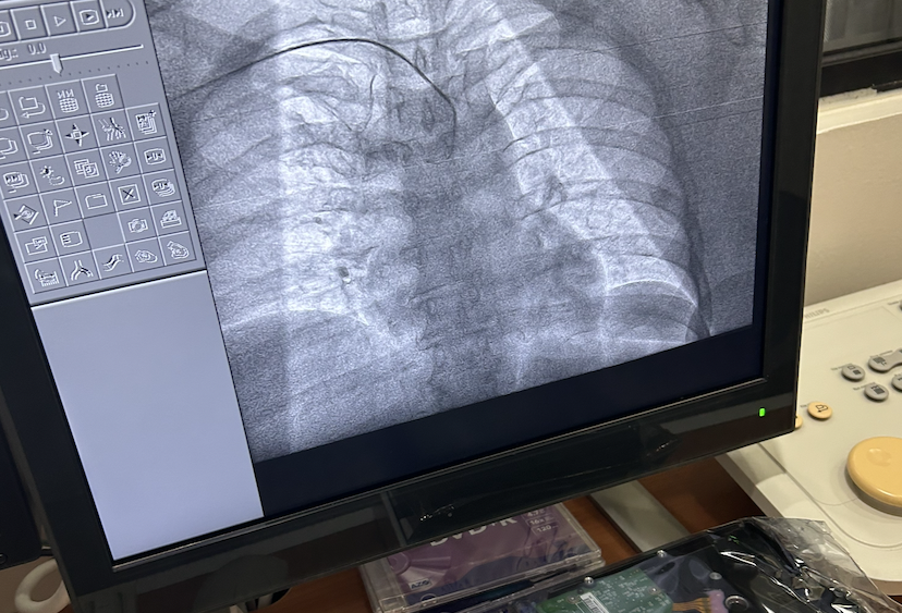Imagen de fluoroscopía en el monitor del sistema Philips Allura FD20 durante el diagnóstico