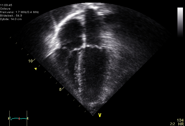 Ecocardiograma en vista de cuatro cámaras con cavidades cardiacas visibles